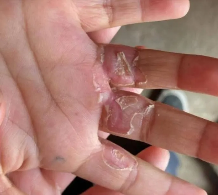 ¡Indignante! Queman manos a menores de 4 y 6 añitos en Los Reyes La Paz; madre y padrastro, involucrados