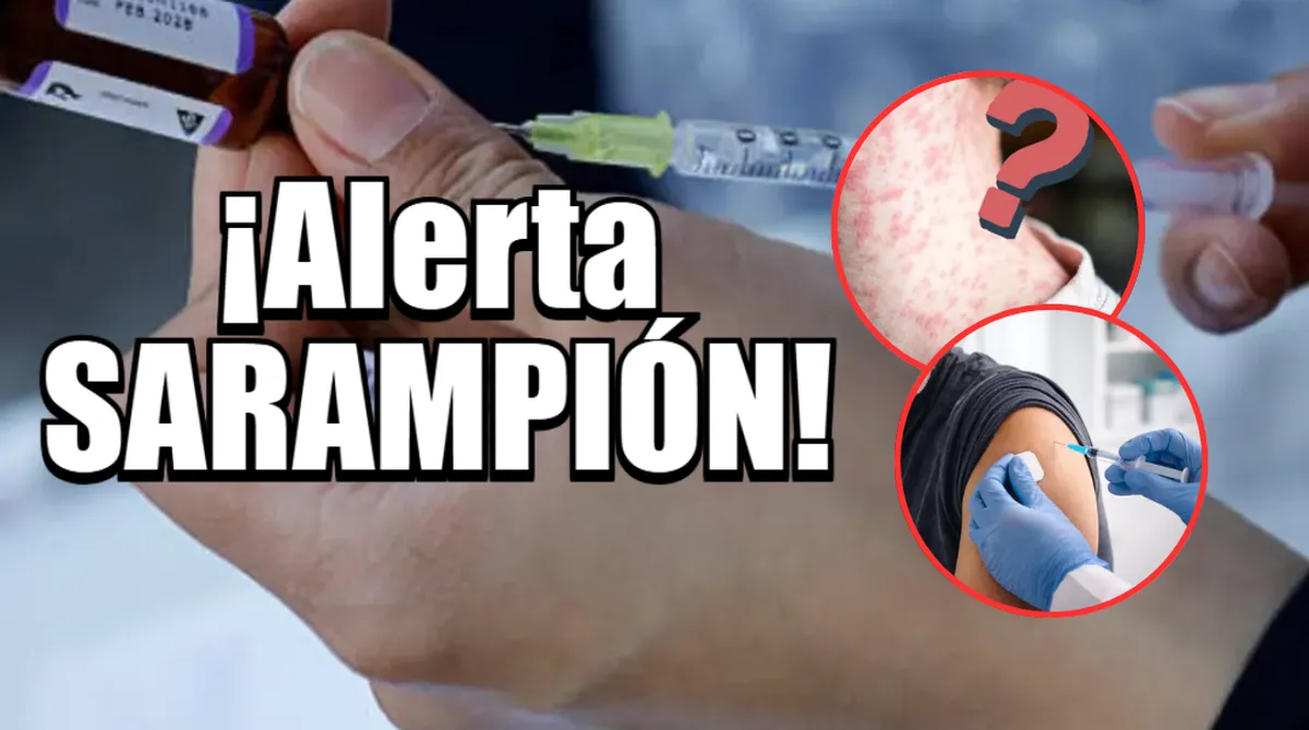 ¡Alerta por Sarampión! ¿Quiénes deben aplicarse la vacuna y cuál es la dosis en Edomex?