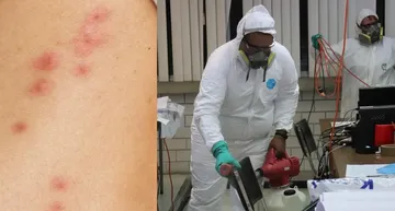 Chinches causan alergias y daños en la piel: Dermatólogos