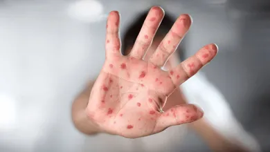 Casos de sarampión podrían incrementar en Edomex por movilidad de periodo vacacional