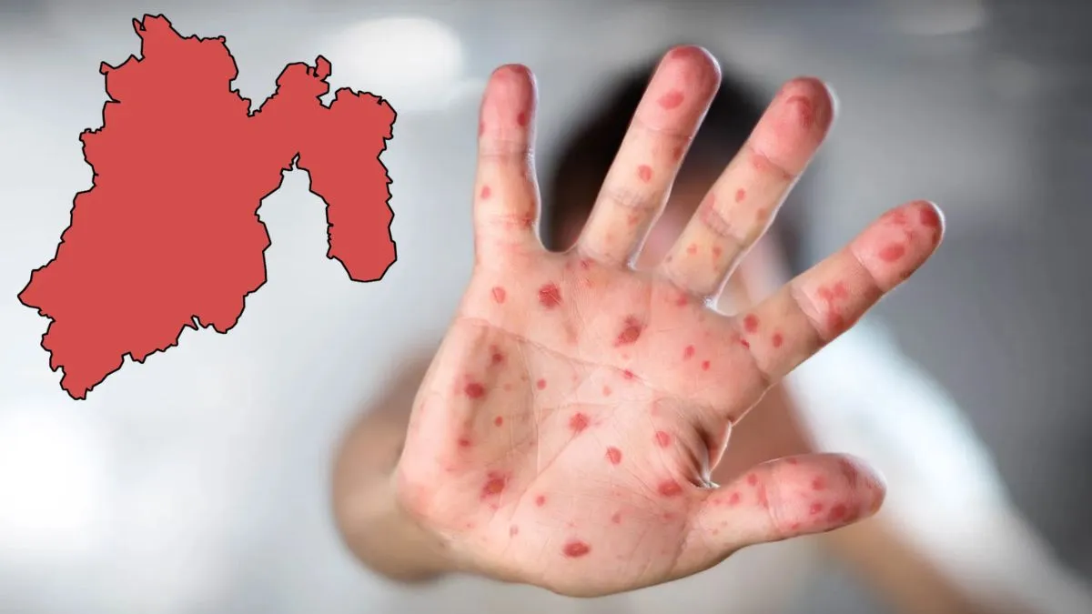 Edomex llega a 63 casos de sarampión; secretaria de Salud asegura que está controlado