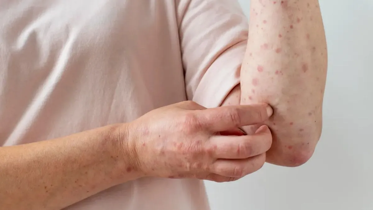 Edomex tiene confirmados 12 casos de sarampión