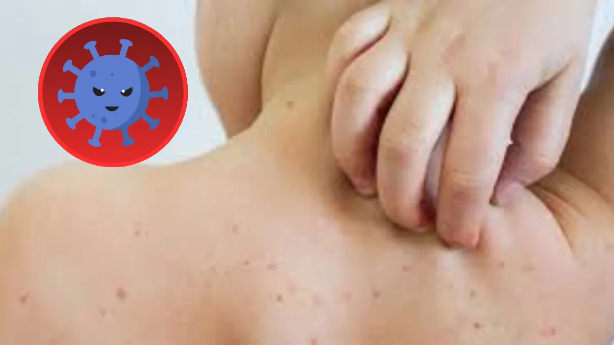 Edomex suma 11 nuevos contagios de sarampión esta semana