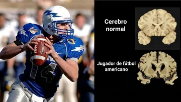 Encefalopatía traumática crónica: ¿Qué es y por qué 1 de cada 4 jugadores de la NFL la padece?