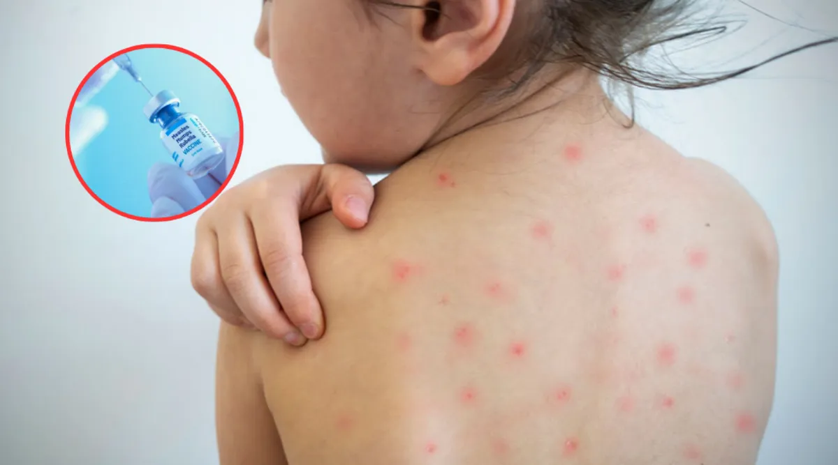 Edomex tiene 142 casos de sarampión