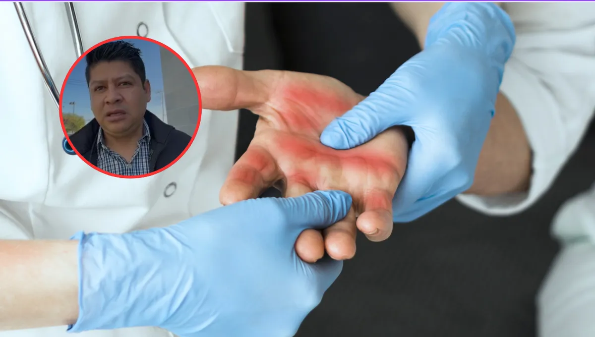 Atención a quemados 2026: Cómo funciona el nuevo sistema de emergencia en Edomex