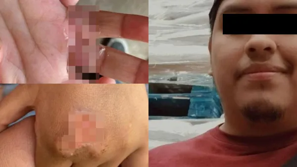 Dos menores en Edomex fueron víctimas de maltrato; madre y padrastro detenidos por quemarles las manos.