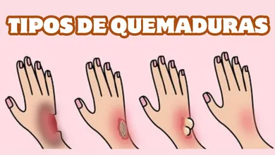 Quemaduras de primer, segundo y tercer grado, ¿cómo identificarlas?