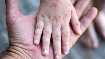 ¡Contagios siguen! Ya son 29 casos de sarampión en el Estado de México