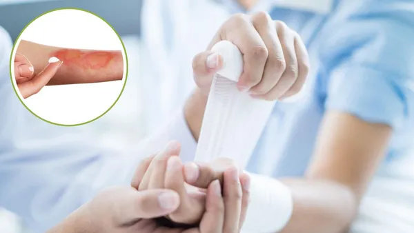 Cuidados médicos ante quemaduras