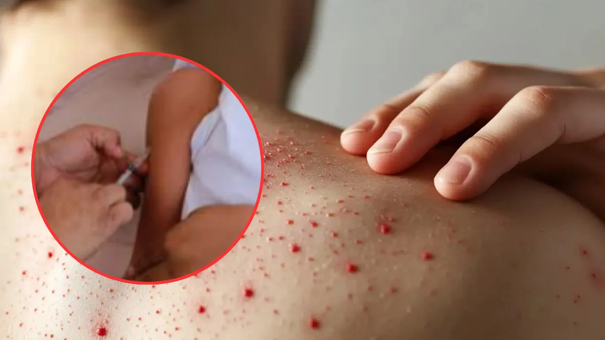 Alerta Sanitaria: Edomex escala al cuarto lugar nacional en contagios de sarampión