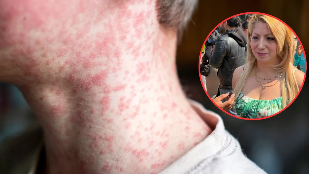 ¿Hay brote de sarampión en el Edomex? Esto dice la Secretaría de Salud