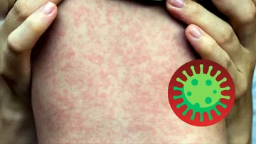 Ya son 111 casos de sarampión confirmados en Edomex