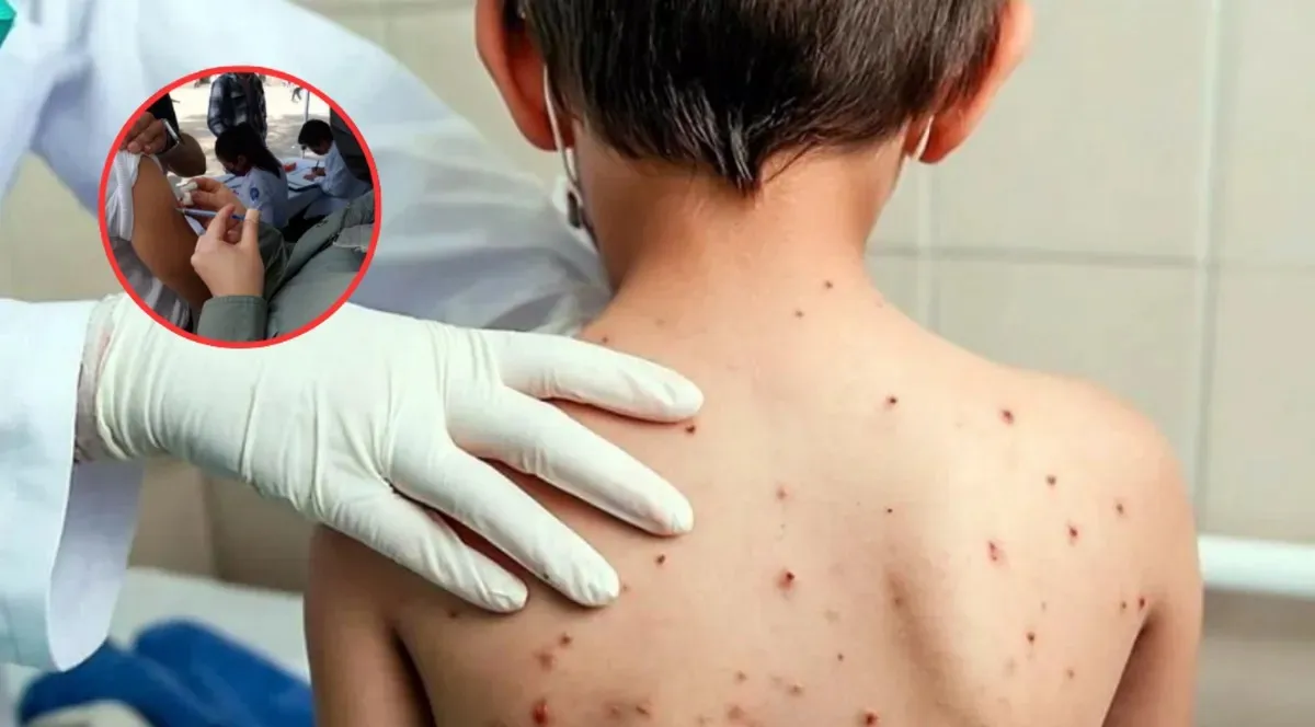 Van 19 casos de sarampión confirmados en Edomex