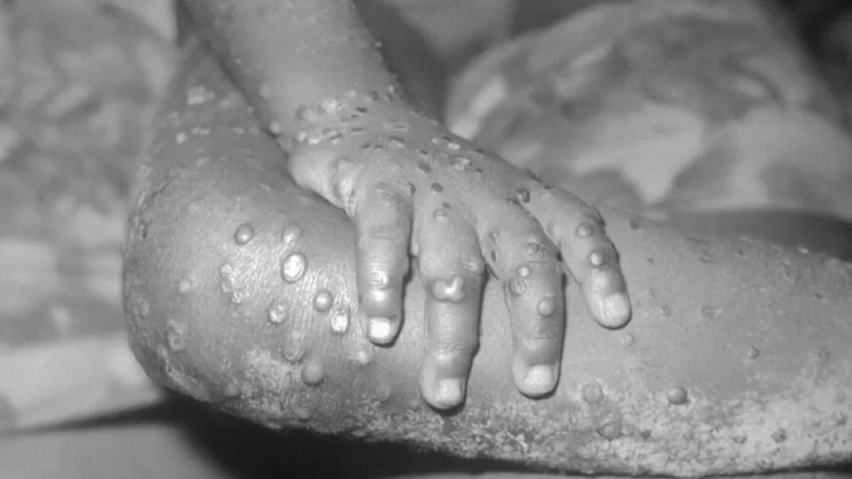 EU reporta primer caso de viruela del mono en Massachusetts