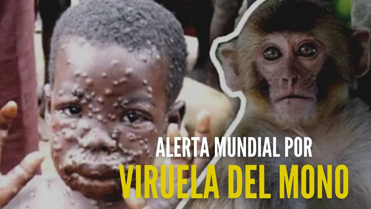 SÍNTOMAS Y FORMAS DE CONTAGIO DE LA VIRUELA DEL MONO