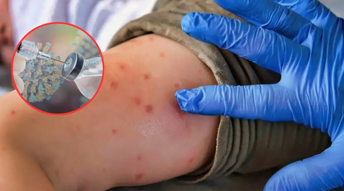 Sin brotes de sarampión en escuelas del Edomex: Salud reporta 29 casos leves