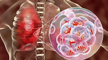 Tuberculosis, de las más mortales a nivel mundial: Epidemiólogo