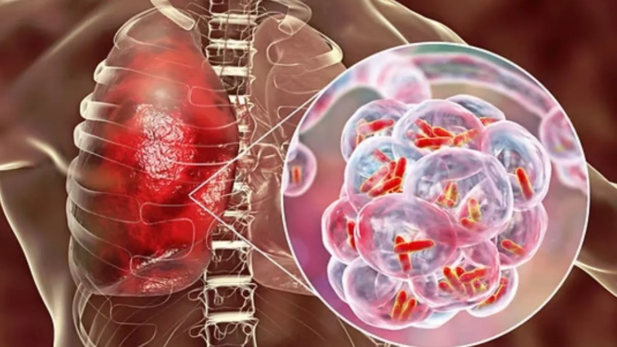 Tuberculosis, de las más mortales a nivel mundial: Epidemiólogo